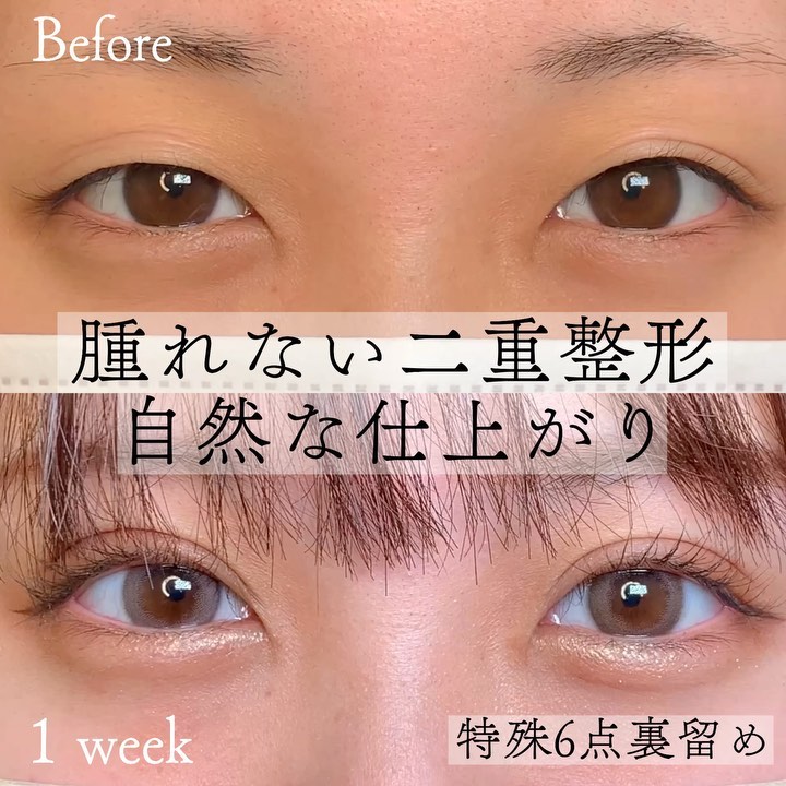 特殊6点裏留め