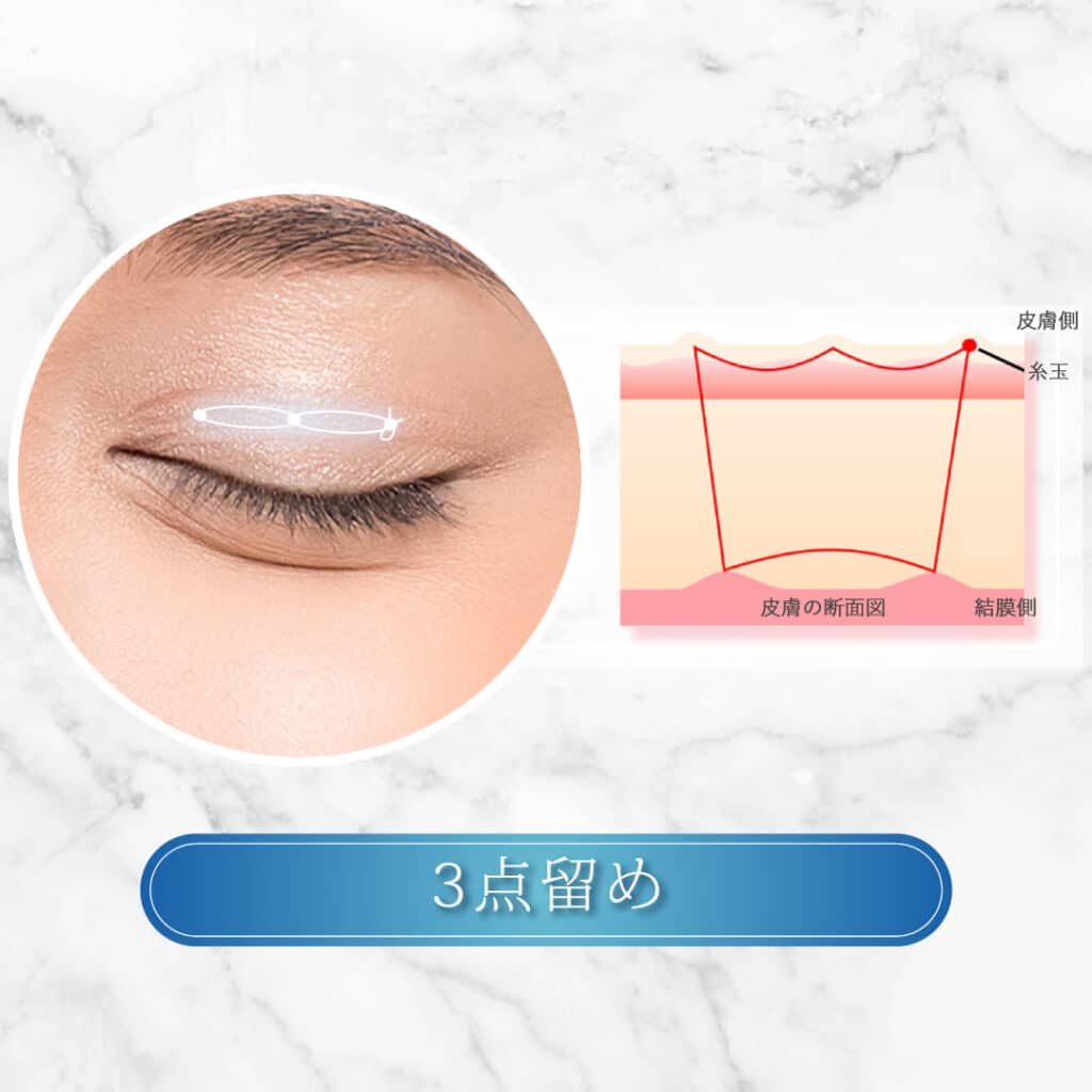 3点留め
