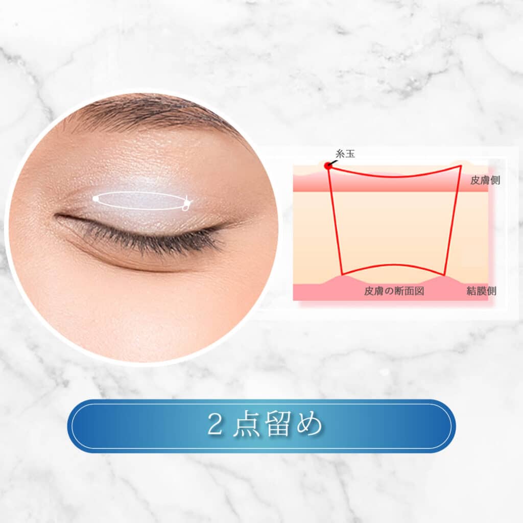 2点留め