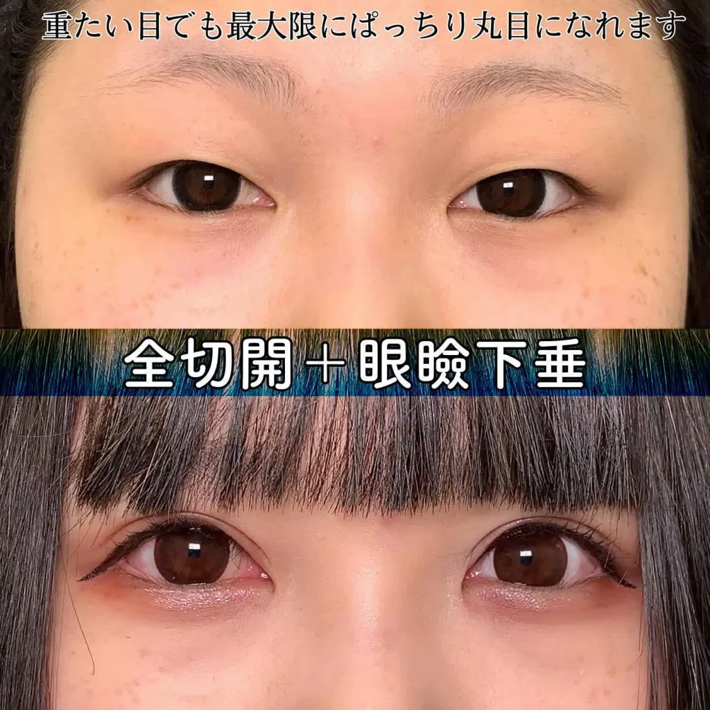全切開 眼瞼下垂