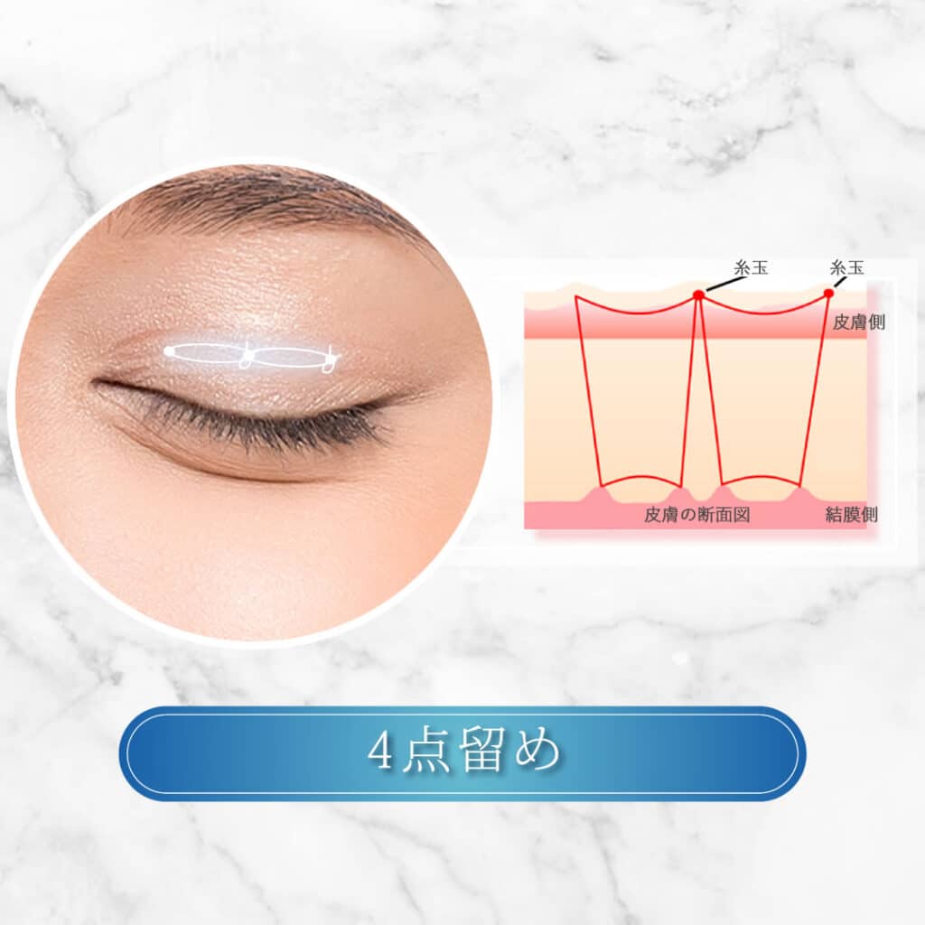 4点留め