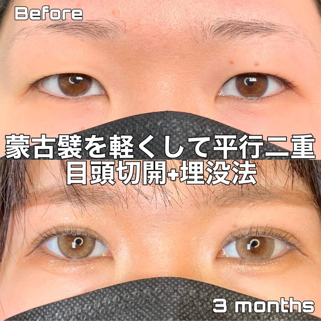 目頭切開 埋没