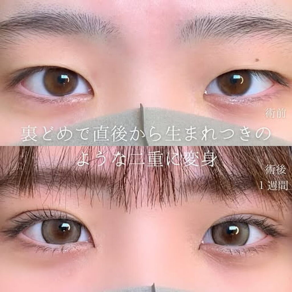 裏どめ