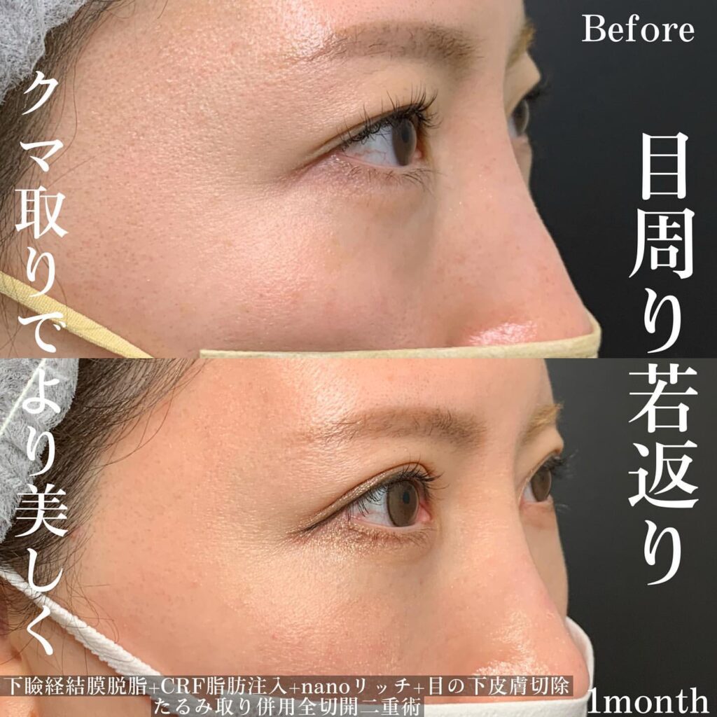 脱脂 脂肪注入 皮膚切除 たるみ取り 全切開