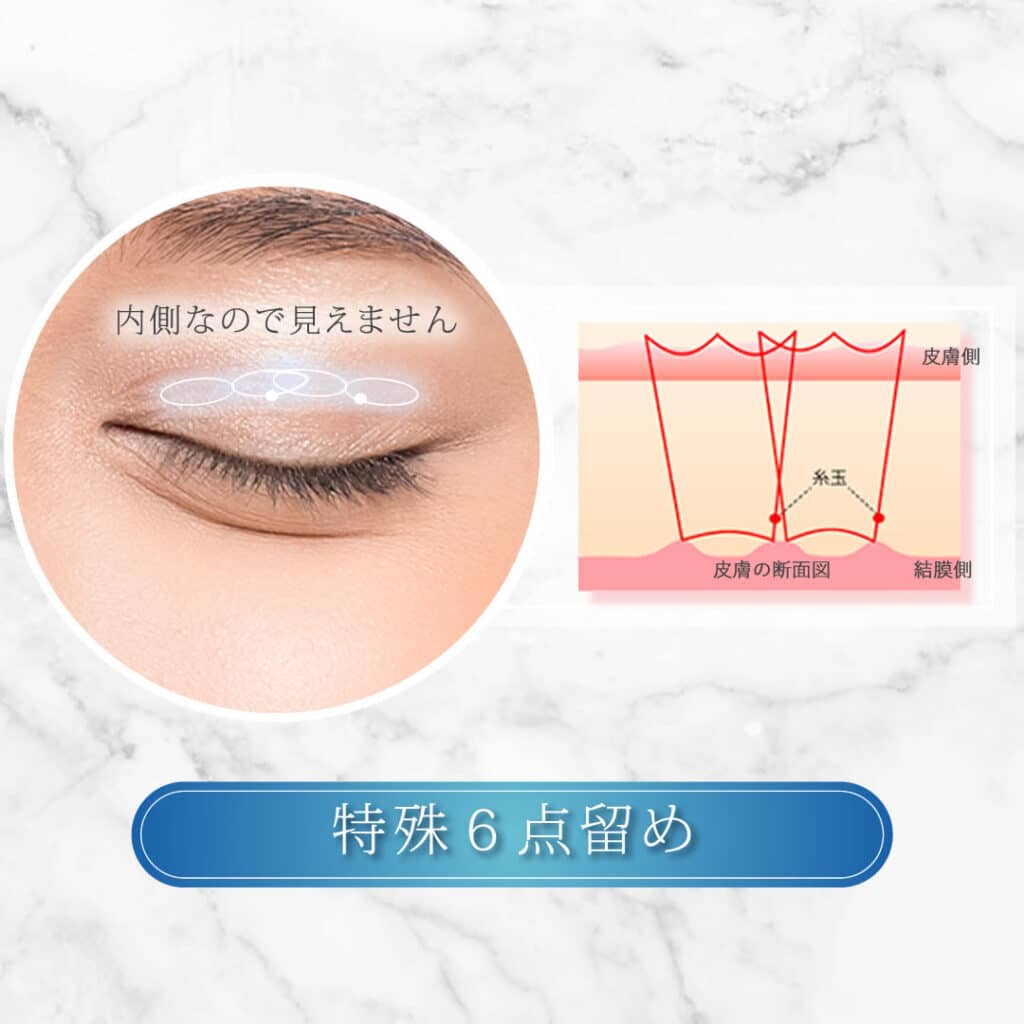 特殊6点裏留め