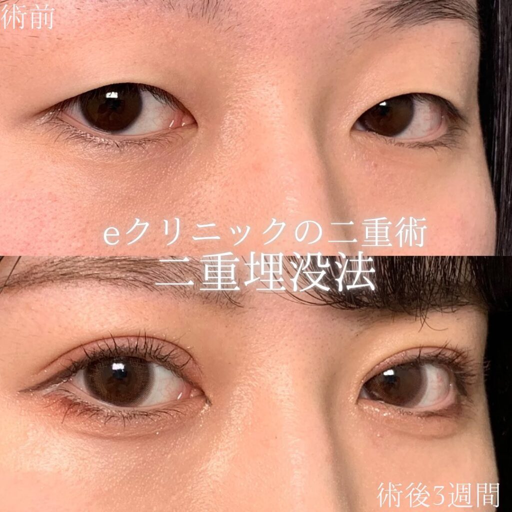 埋没