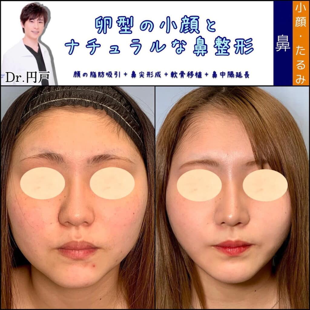 eclinic横浜みなとみらい院の顔の脂肪吸引と鼻尖形成と軟骨移植と鼻中隔延長の症例写真