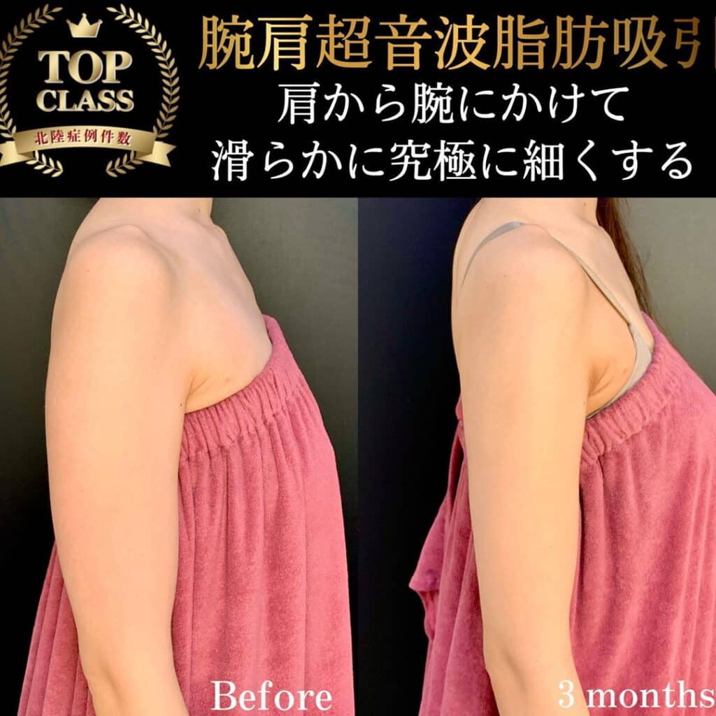 eclinic横浜みなとみらい院の腕脂肪吸引の症例写真