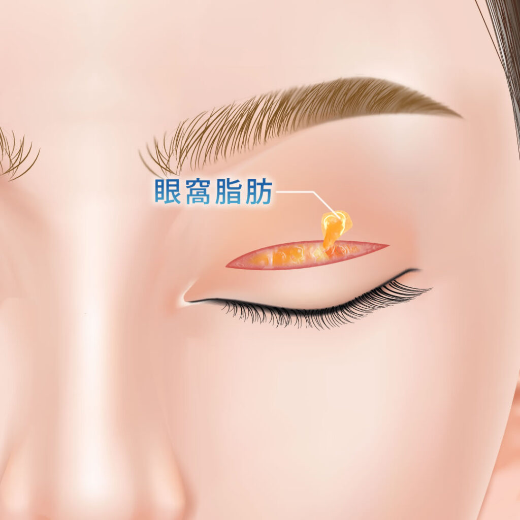 全切開の手術時の眼窩脂肪の除去の図解