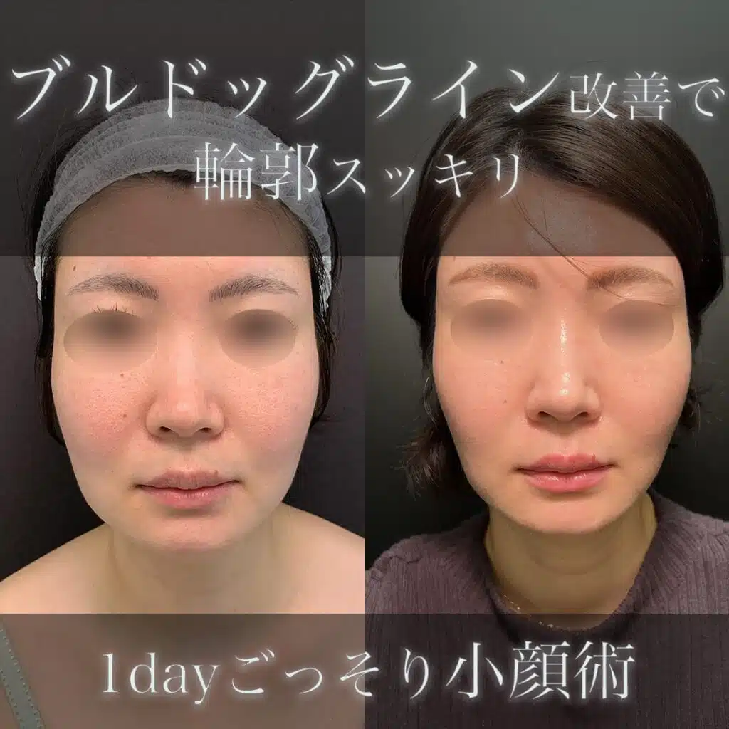 顔の脂肪吸引