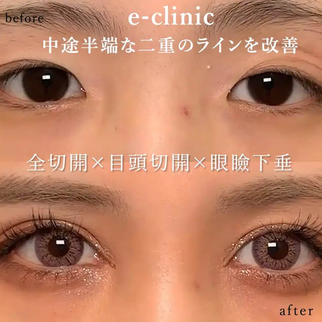 全切開 目頭切開 眼瞼下垂