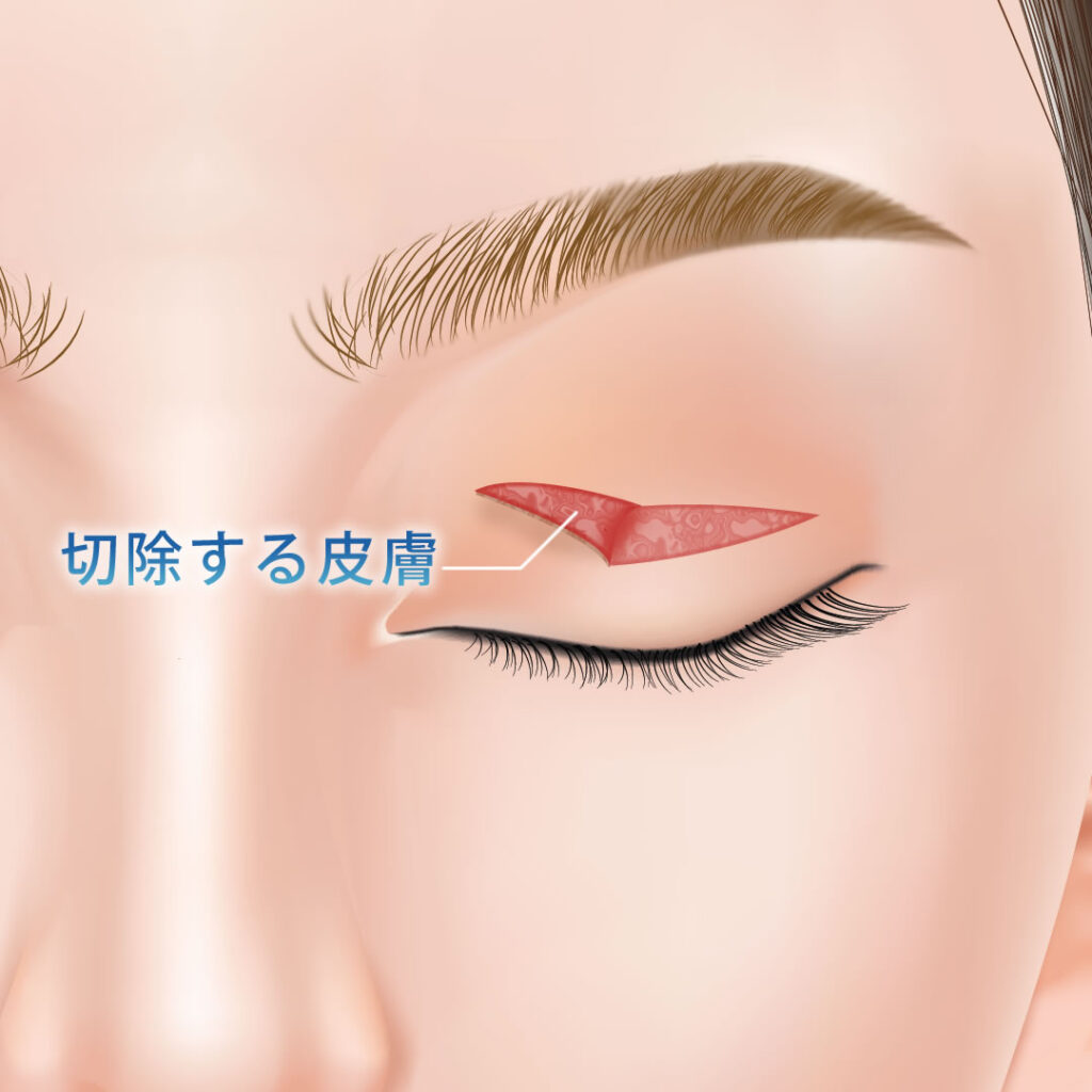 皮膚切除