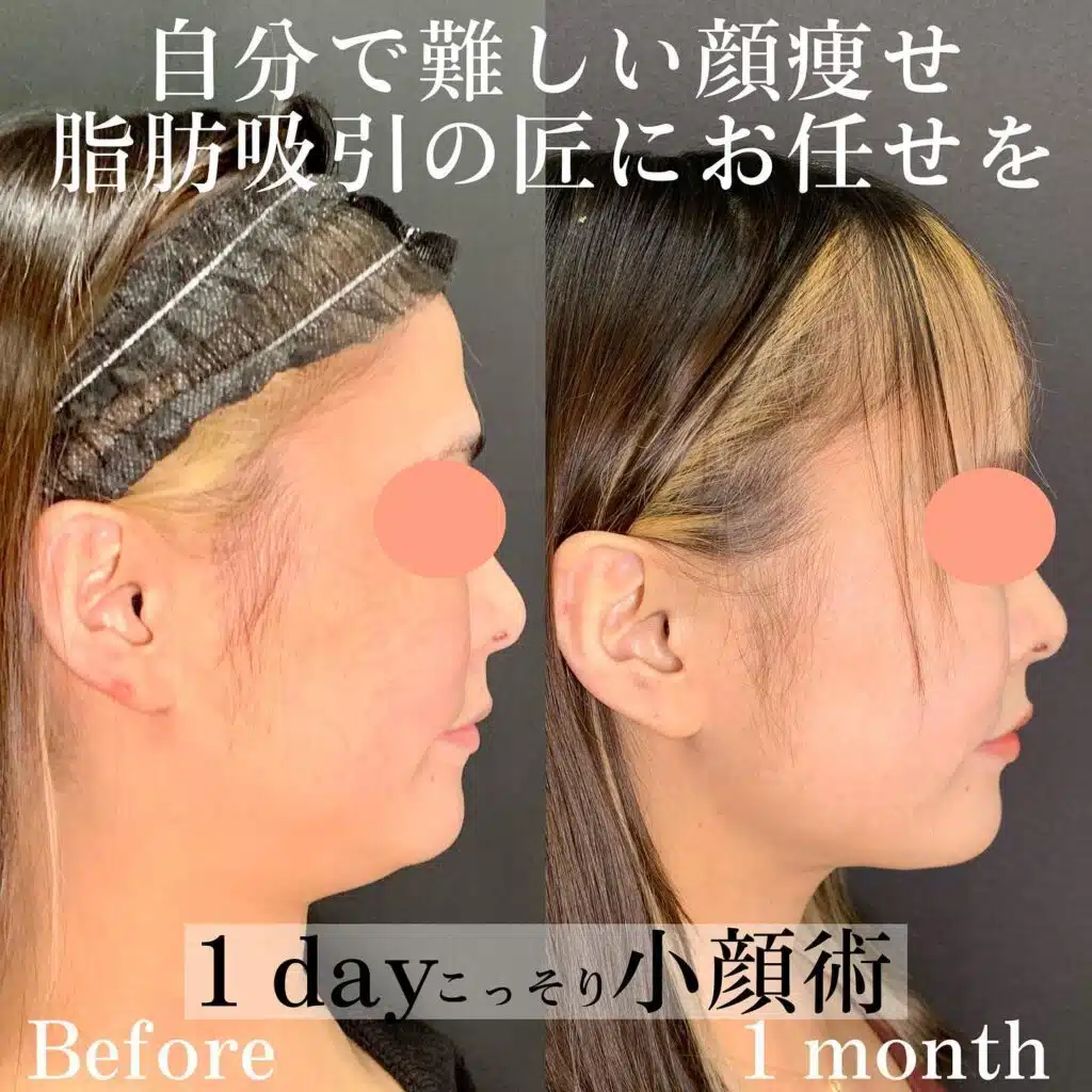 顔の脂肪吸引