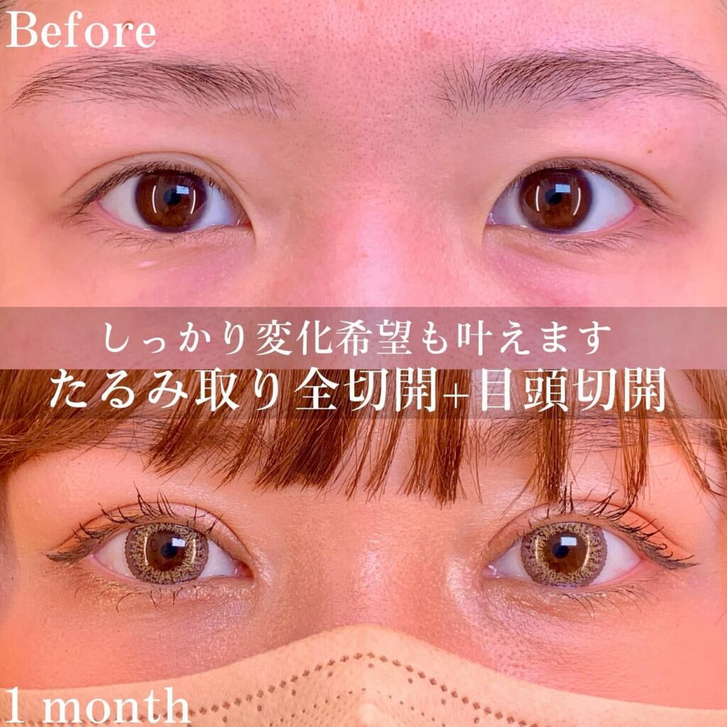 eclinic横浜みなとみらい院のたるみ取り併用全切開二重術+目頭切開