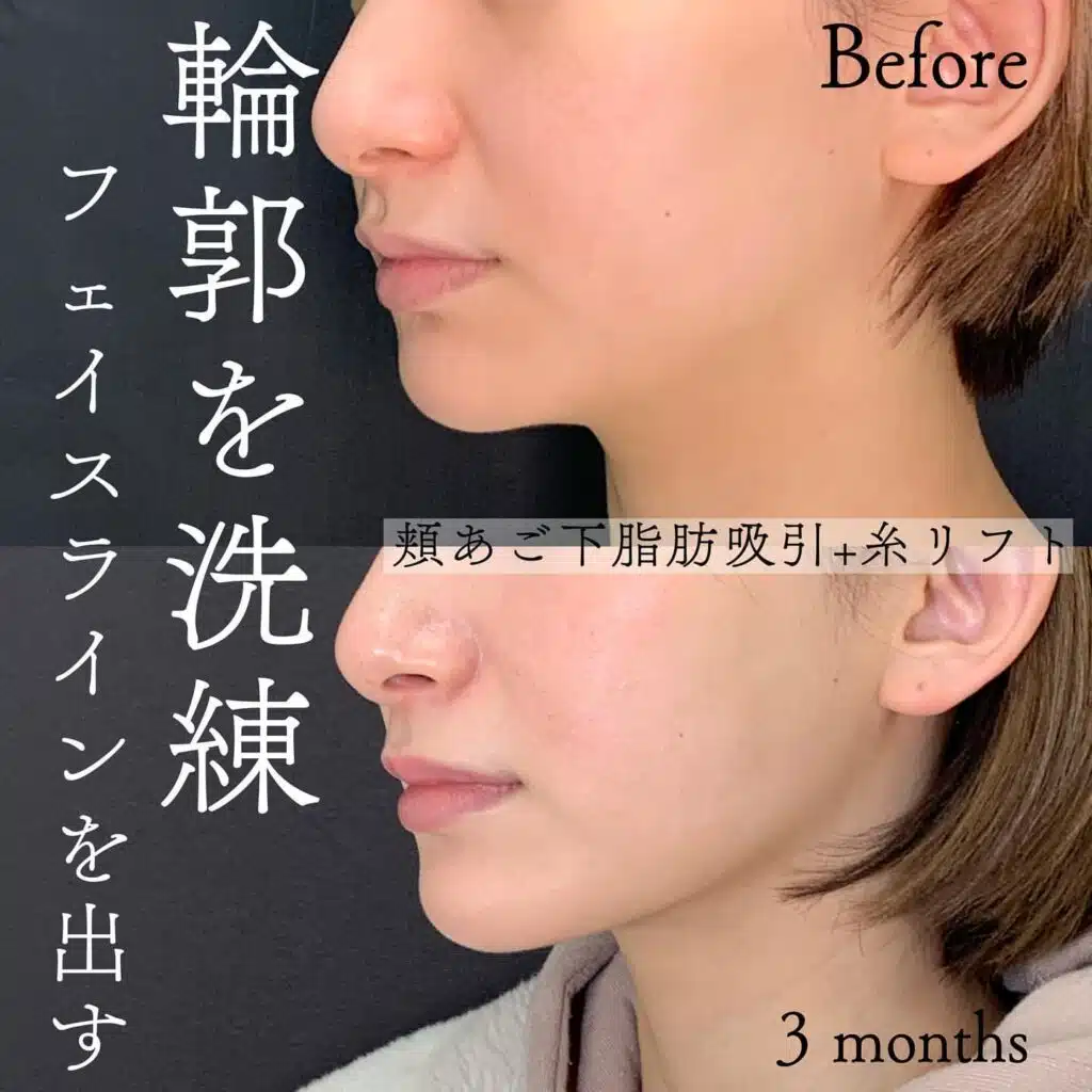 顔の脂肪吸引