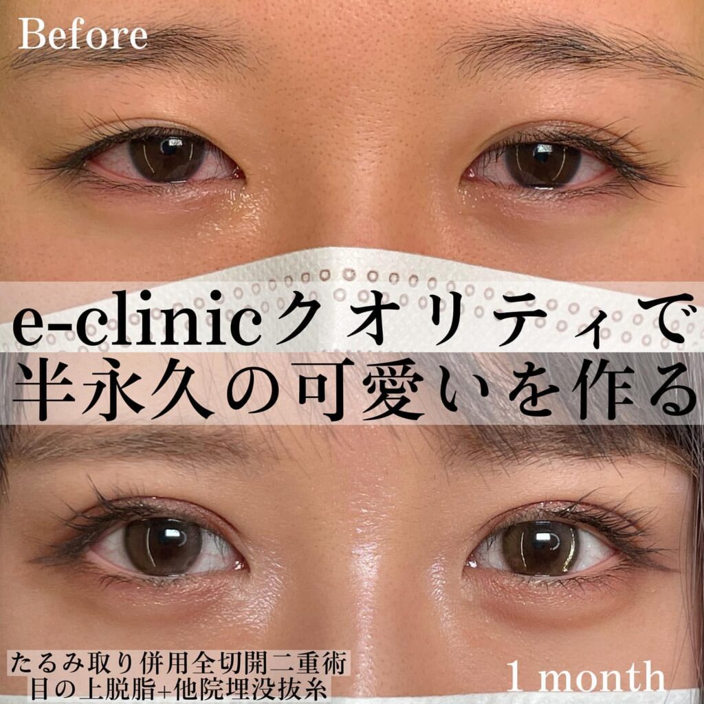 eclinic横浜みなとみらい院のたるみ取り併用全切開二重術+目の上脱脂+他院埋没抜糸