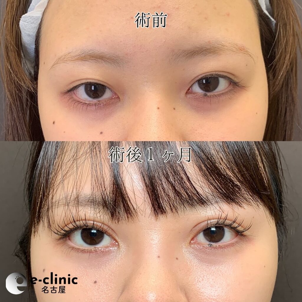 eclinic横浜みなとみらい院の全切開二重術