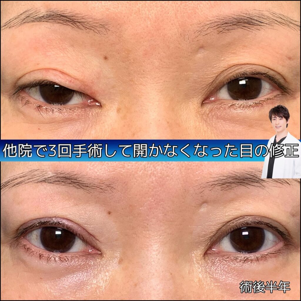 eclinic横浜みなとみらい院の全切開二重術他院修正