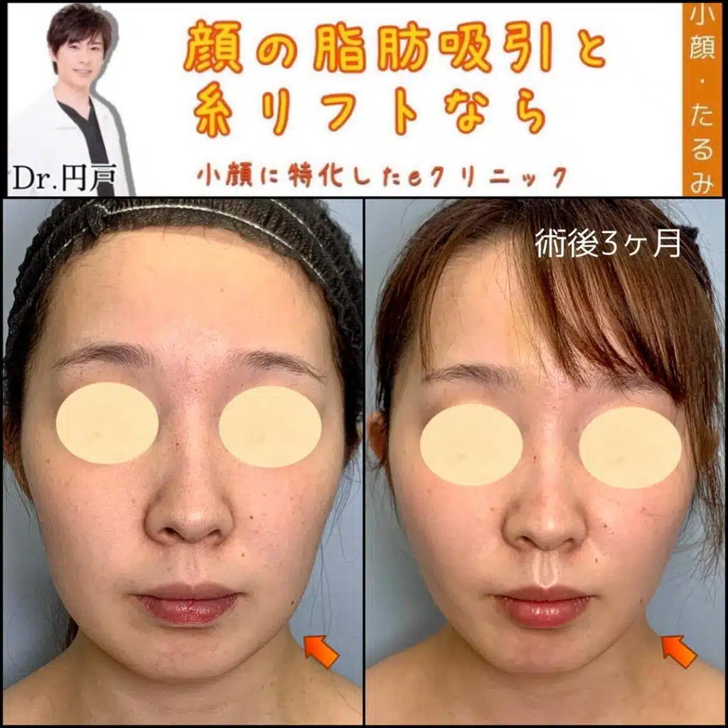 顔の脂肪吸引