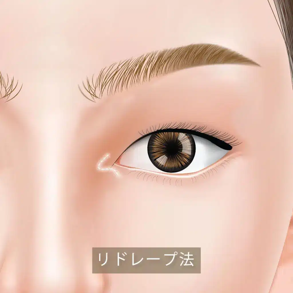 リドレープ