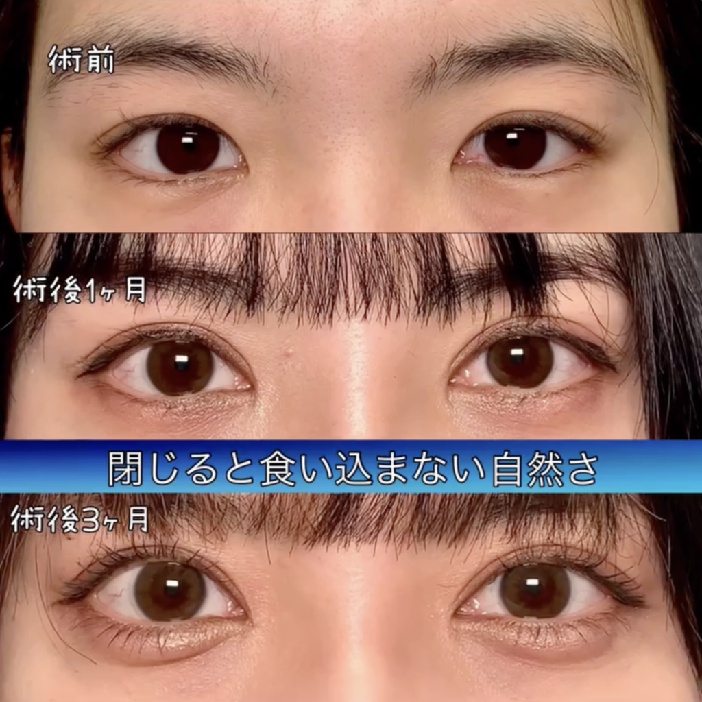 eclinic横浜みなとみらい院の全切開二重術