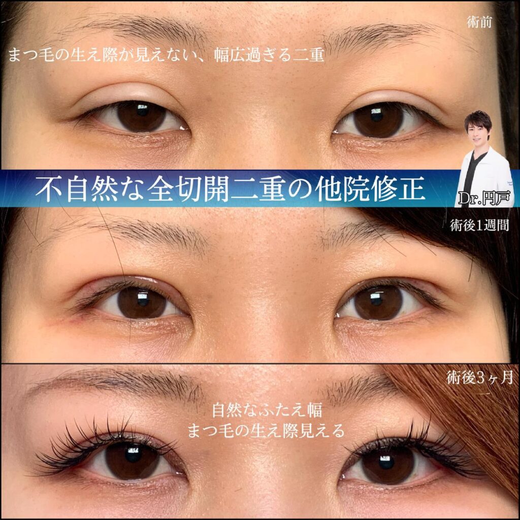 eclinic横浜みなとみらい院の全切開二重術の他院修正
