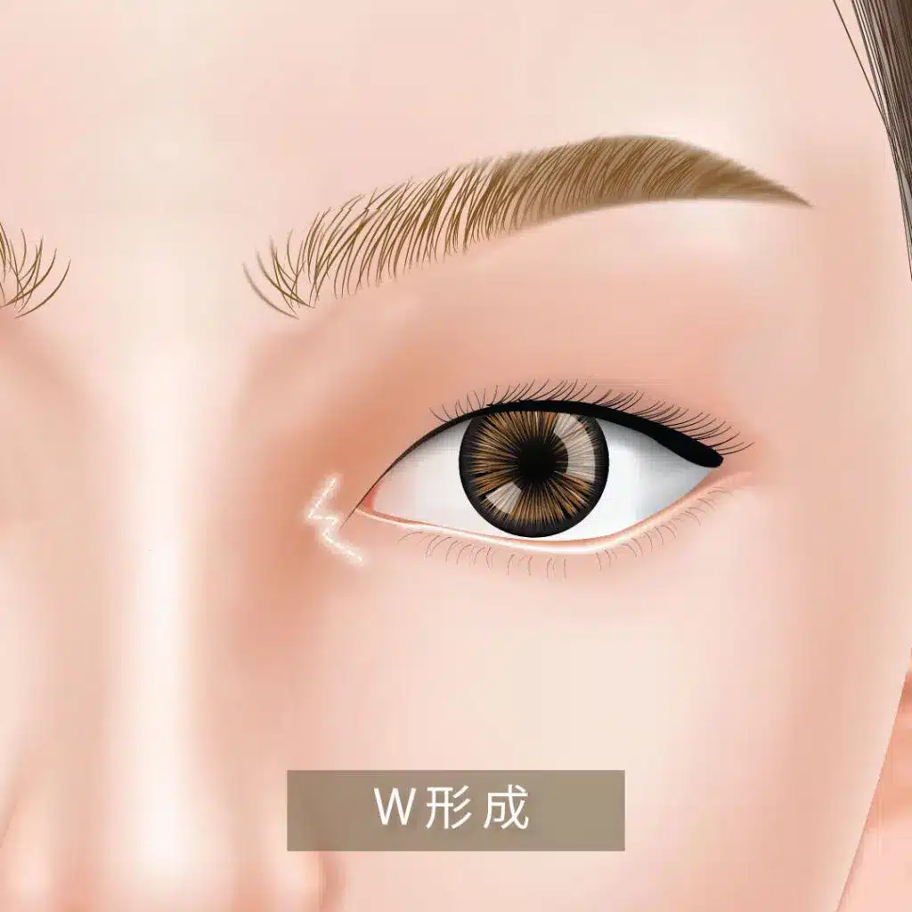 W形成