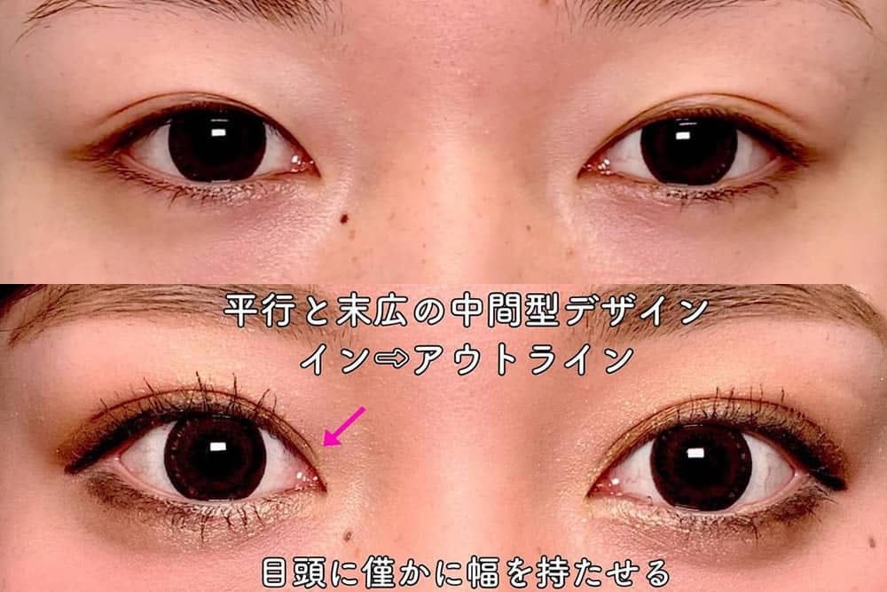 eclinic横浜みなとみらい院の全切開二重術