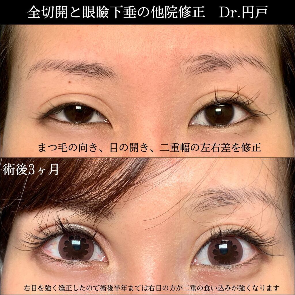 eclinic横浜みなとみらい院の全切開二重術の他院修正+眼瞼下垂
