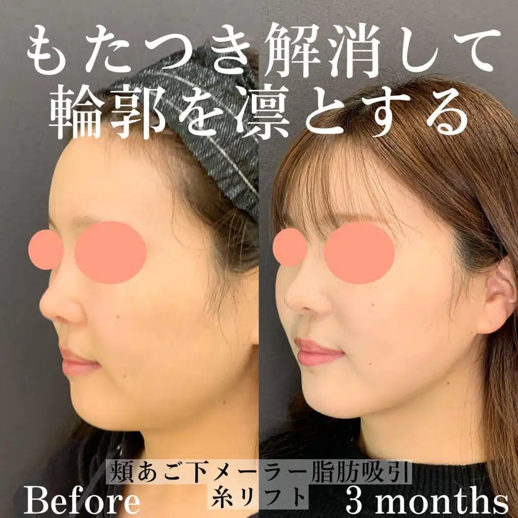 顔の脂肪吸引