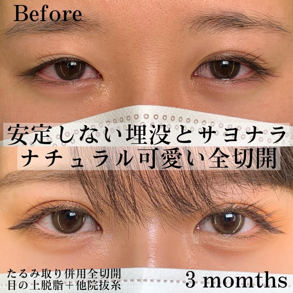 eclinic横浜みなとみらい院のたるみ取り併用全切開二重術+目の上脱脂+他院抜糸