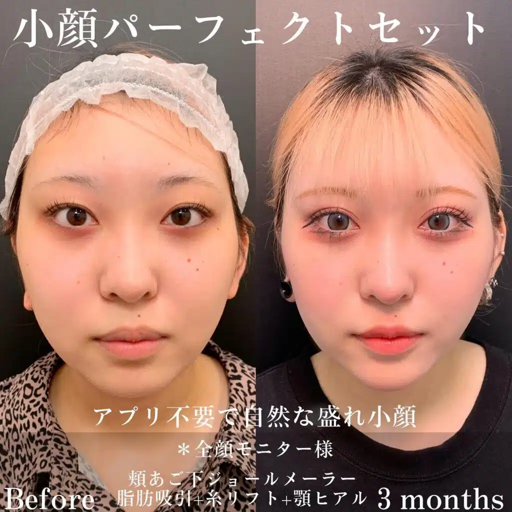 顔の脂肪吸引