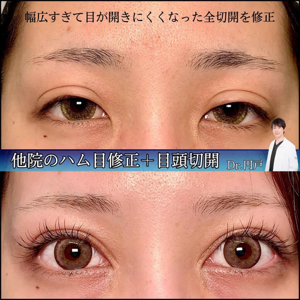 eclinic横浜みなとみらい院の全切開二重術の他院修正(ハム目修正)