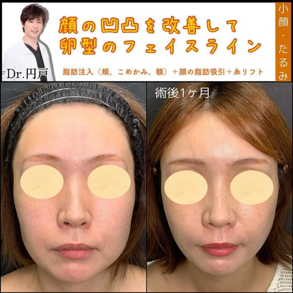 顔の脂肪吸引