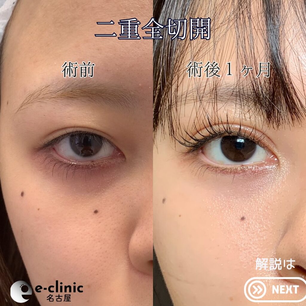eclinic横浜みなとみらい院の全切開二重術