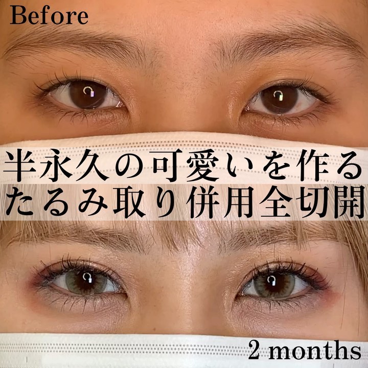 eclinic横浜みなとみらい院のたるみ取り併用全切開二重術