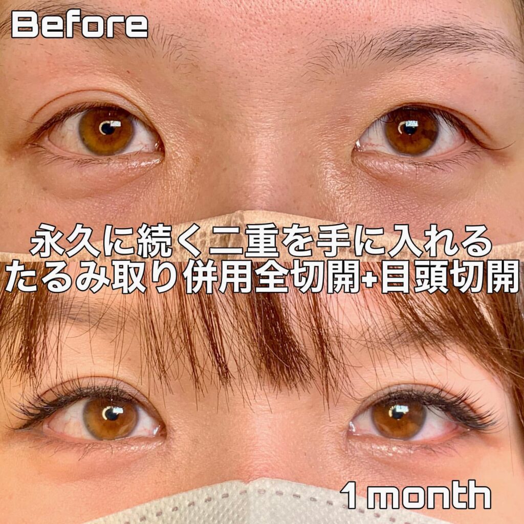 eclinic横浜みなとみらい院のたるみ取り併用全切開二重術+目頭切開