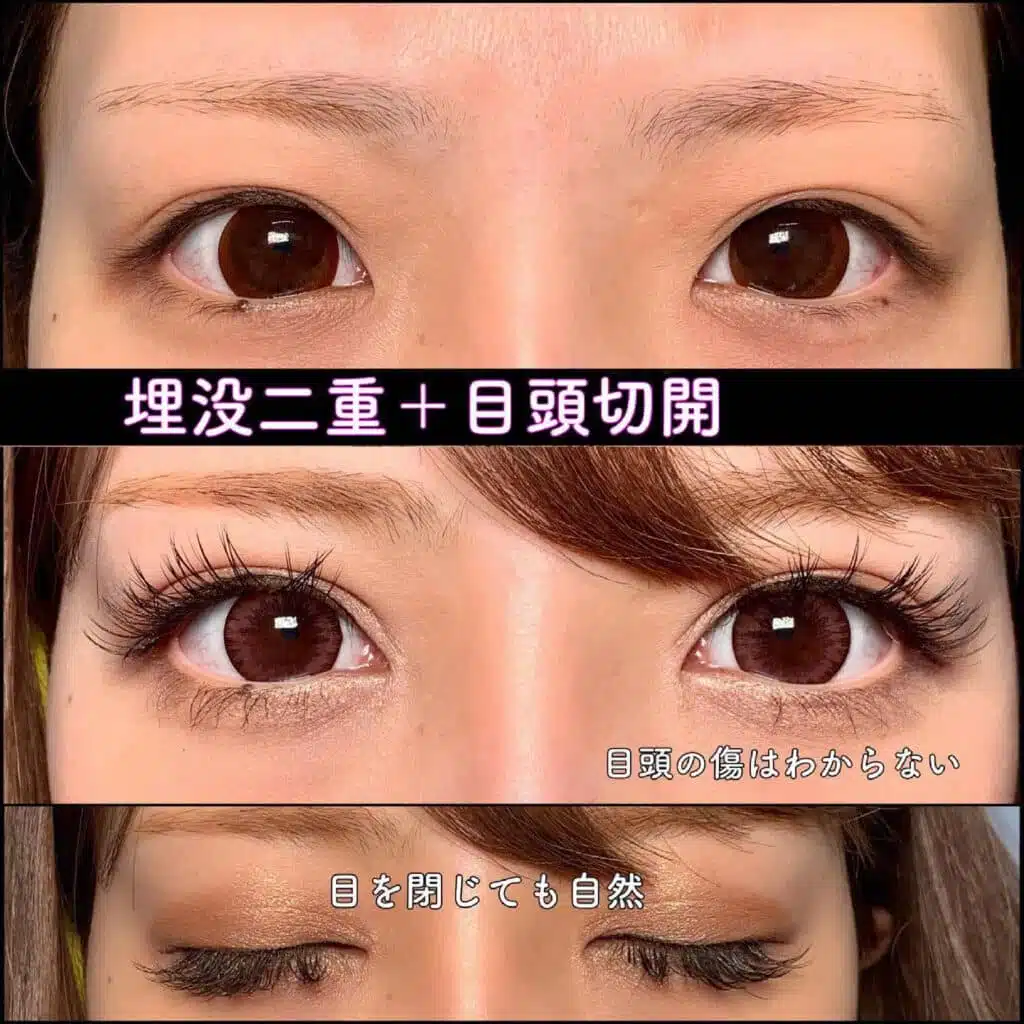 埋没 目頭切開