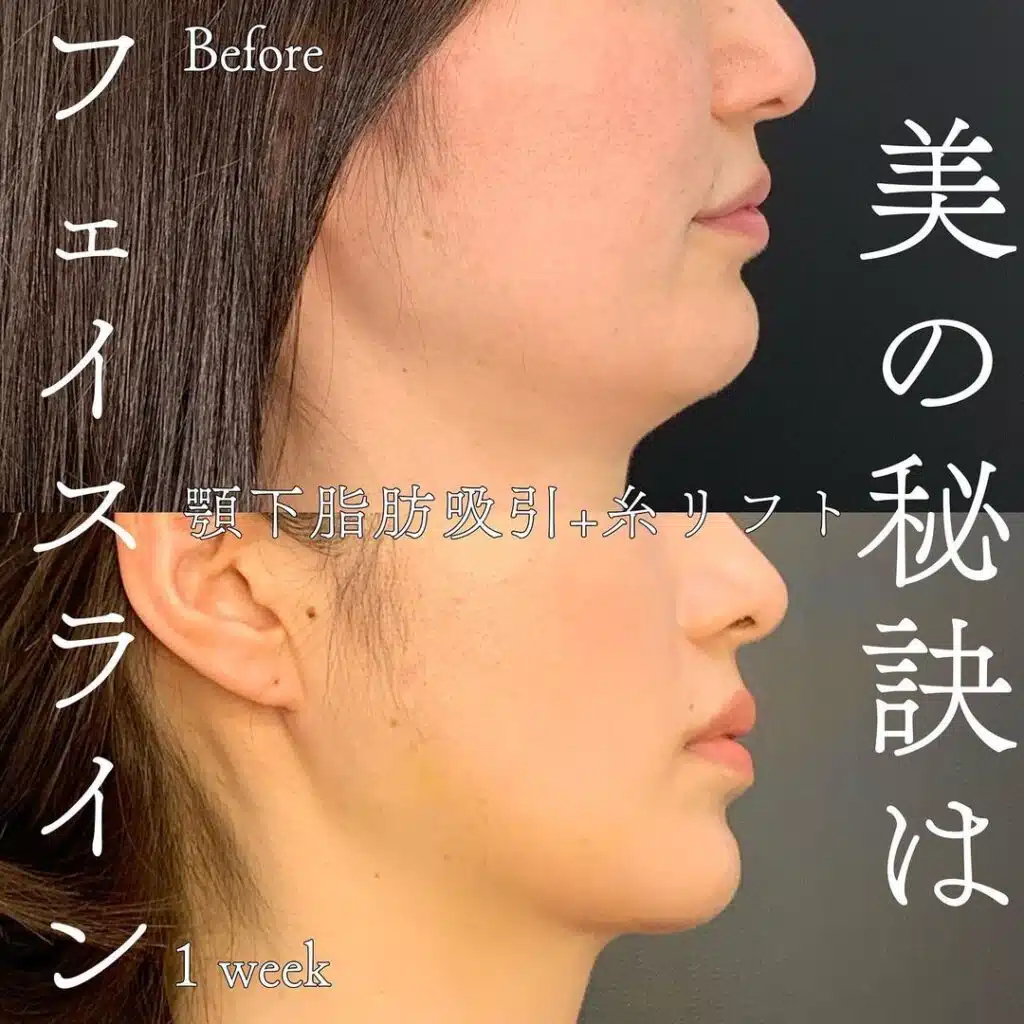 顔の脂肪吸引