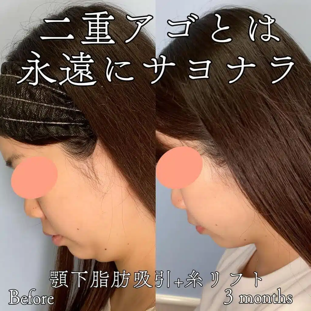 顔の脂肪吸引