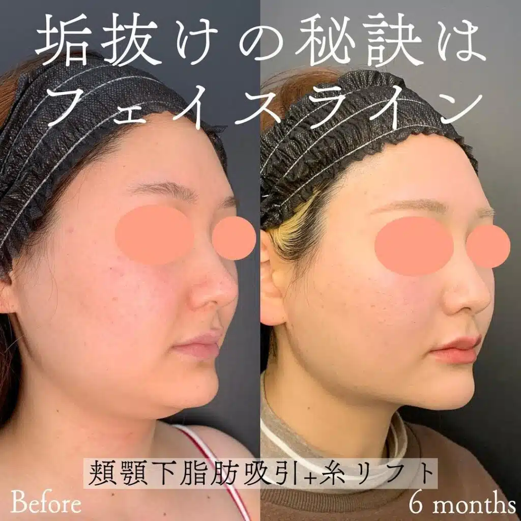 顔の脂肪吸引