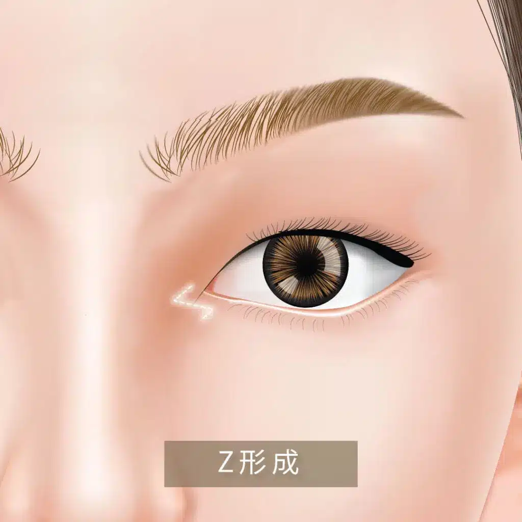 Z形成