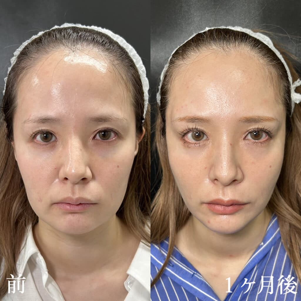 糸リフトの手術前と１か月後の症例写真