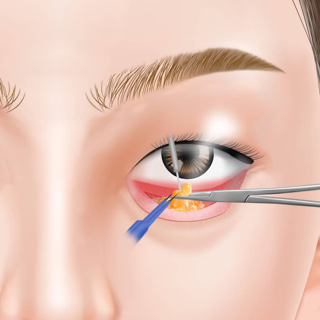 経結膜脱脂で眼窩脂肪を取りだしている図解