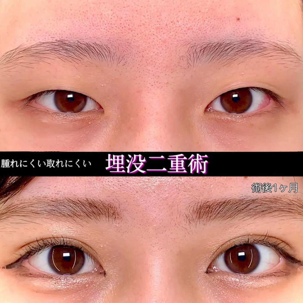 横浜院の埋没法の症例 (15)