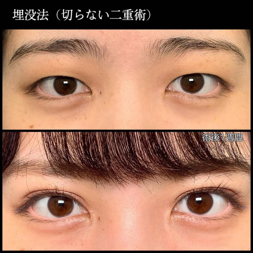 埋没法の症例 (1)