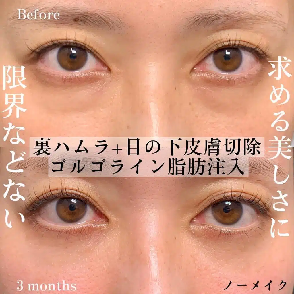 裏ハムラ 皮膚切除 脂肪注入