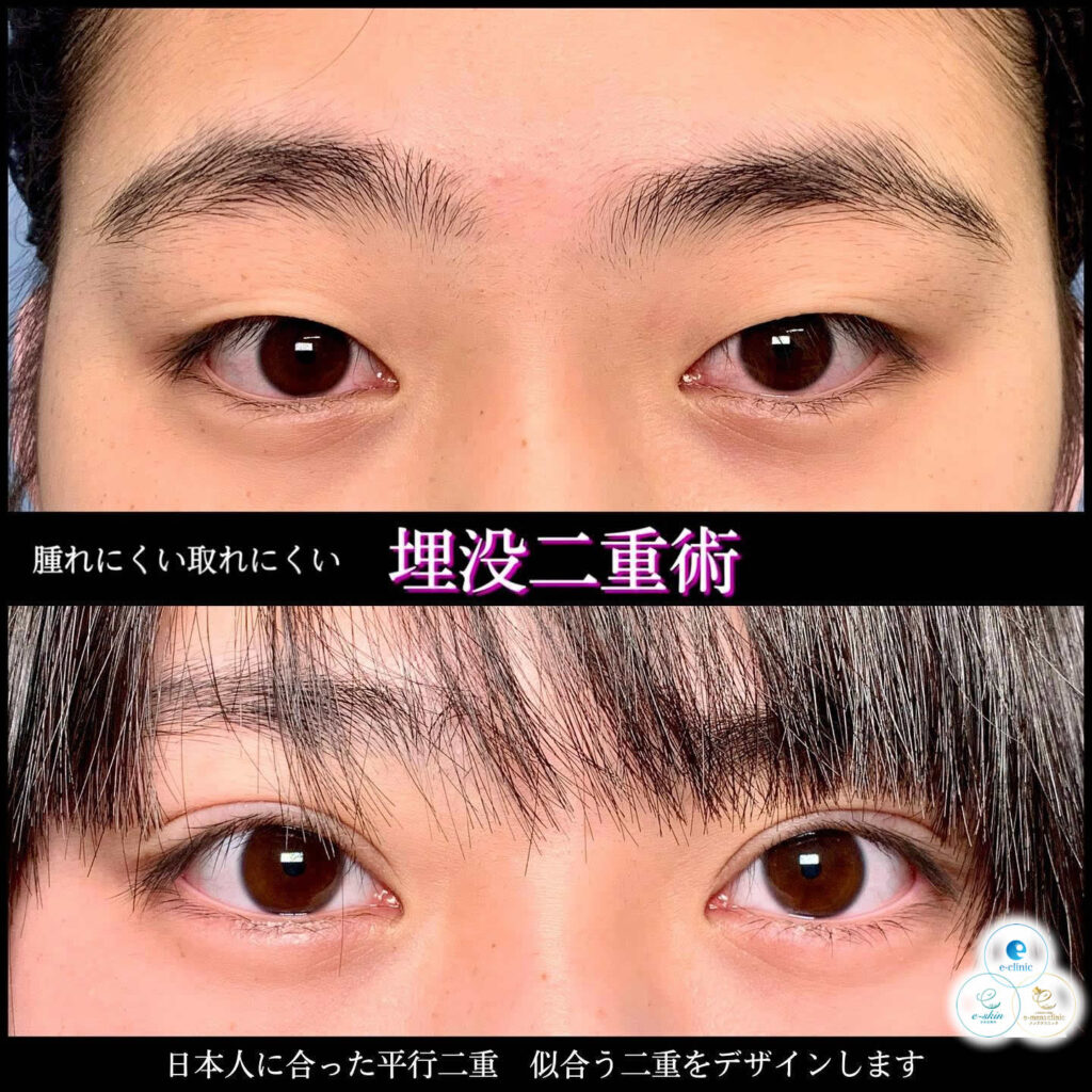 横浜院の埋没法の症例 (15)