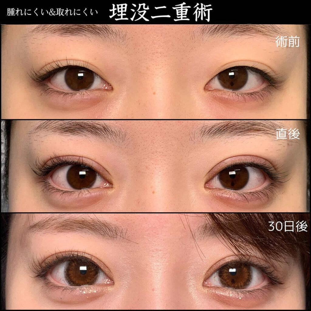 横浜院の埋没法の症例 (15)