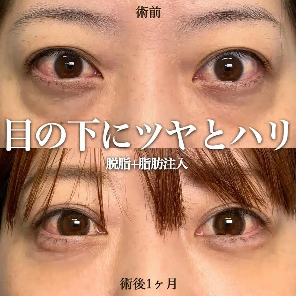 脱脂